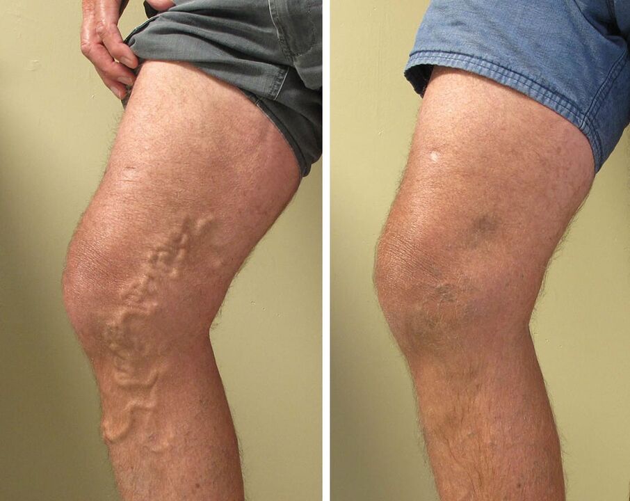 Εμπειρία στη χρήση gel zxcvbnmqwert