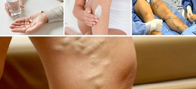 Θεραπεία των φλεβών των κιρσών